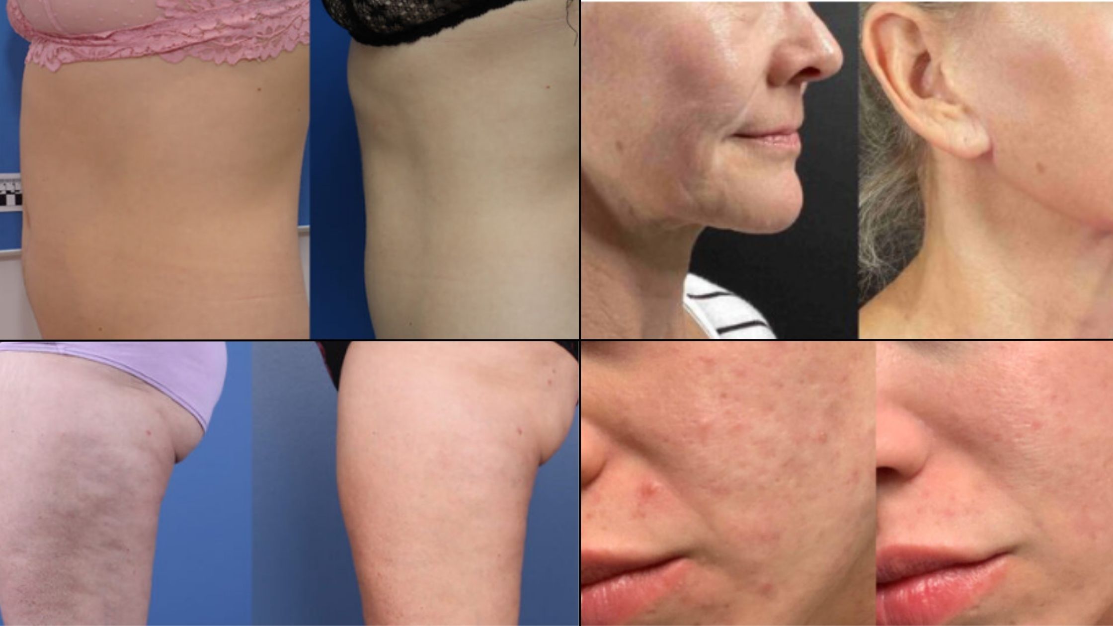 morpheus 8 treatment NYC (2)