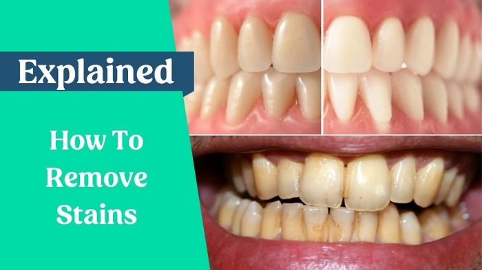 Brown Surface Stains on Teeth Causes and Home Solutions