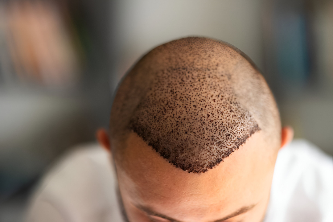 Hair Transplant in Islamabad