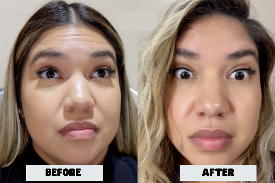 20 units of Botox before and after