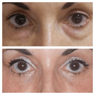 Eye Bag Removal in Dubai