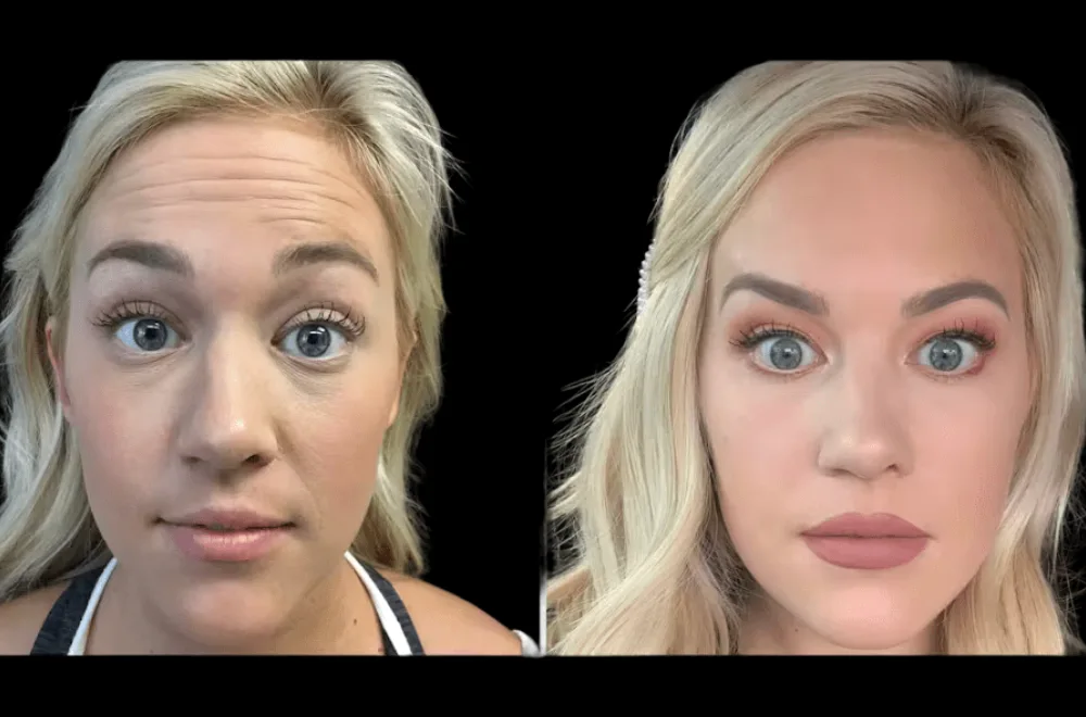 How Long Does Botox Last? Real Facts from the Best Plastic Surgeons in Dubai