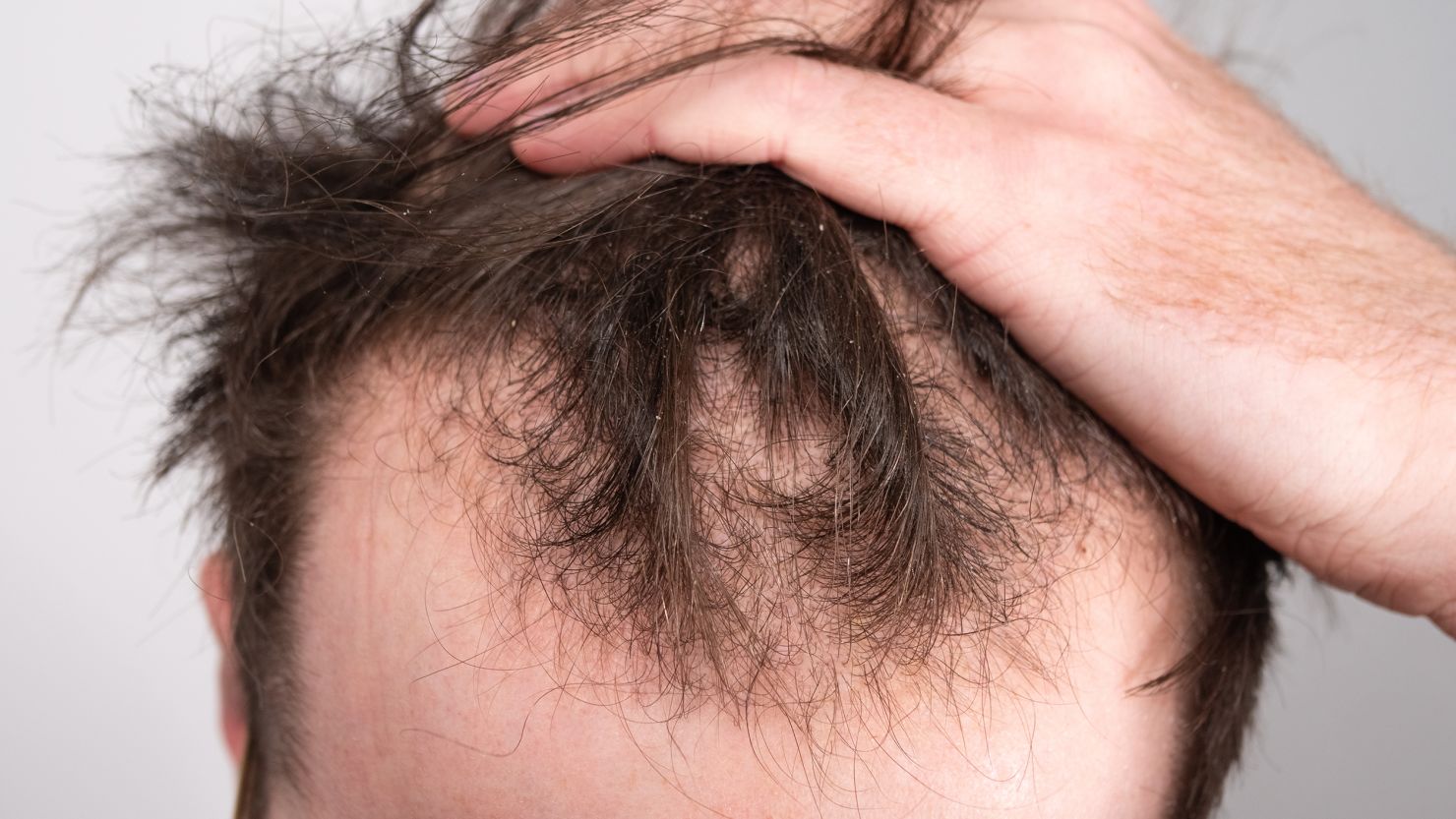 Hair Loss Treatments