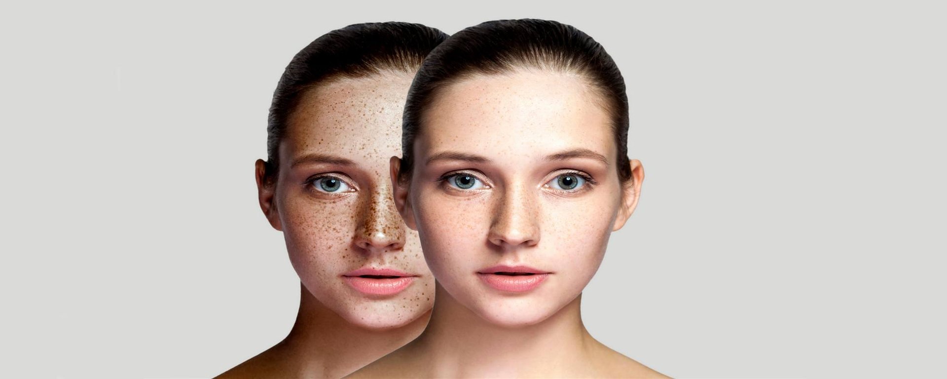 Hyperpigmentation (1)