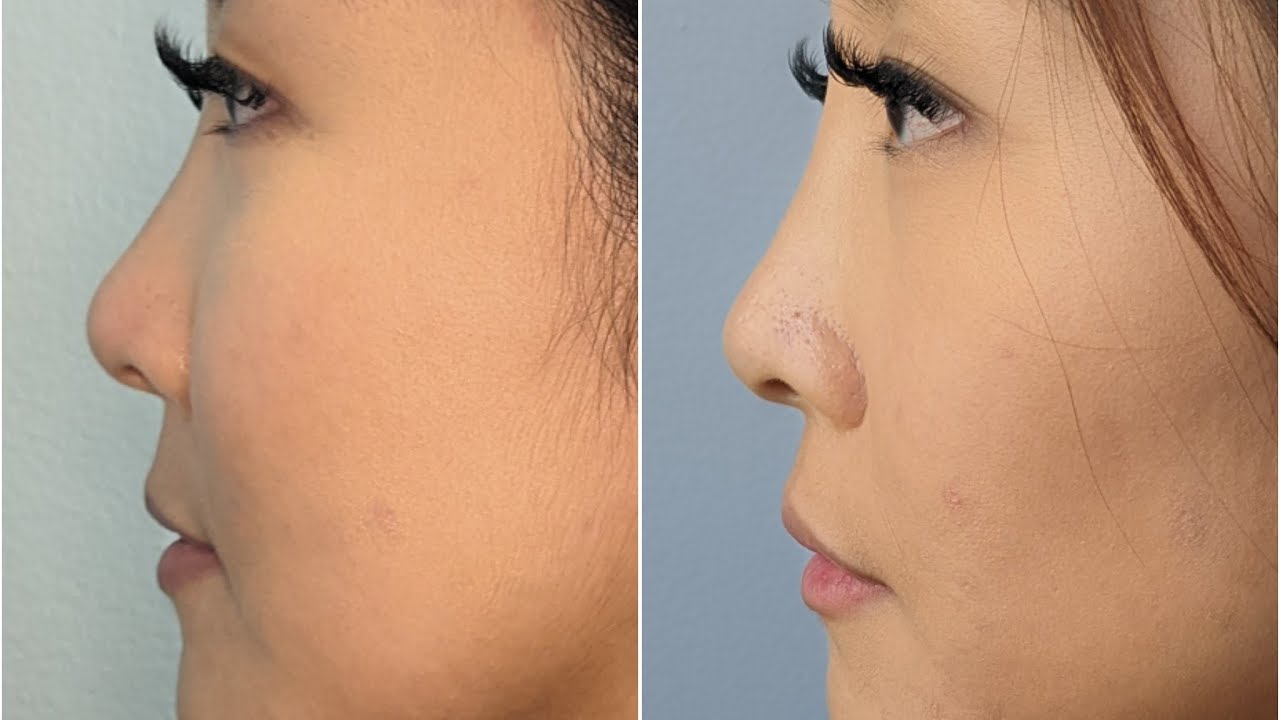 Liquid Rhinoplasty treatment for natural nose contour