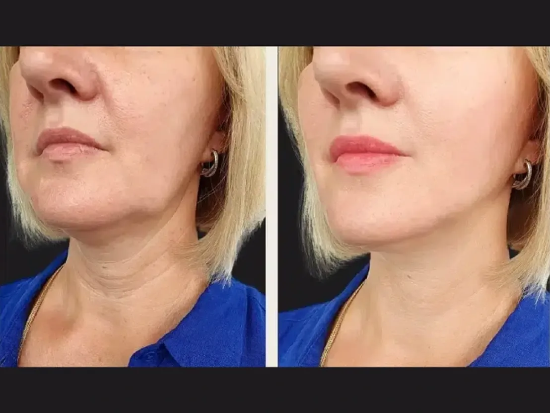 Prp Treatment in Dubai