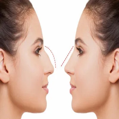 Rhinoplasty in Riyadh for Natural Facial Balance and Refined Results