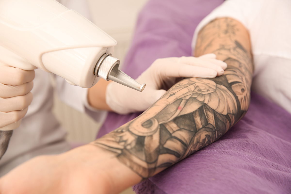 Tattoo Removal Services - Manas Aesthetics