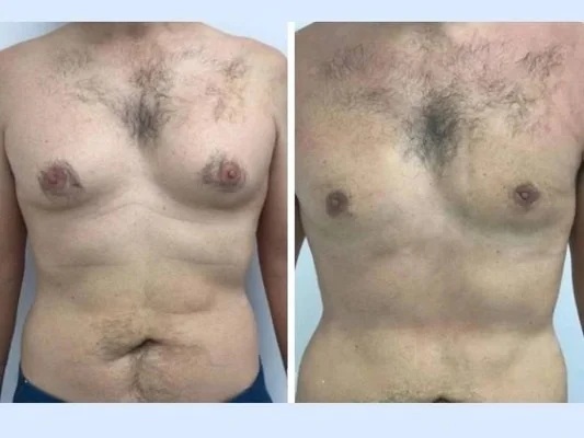 Best Gynecomastia Surgeon in Dubai: Addressing Both Physical and Psychological Transformation