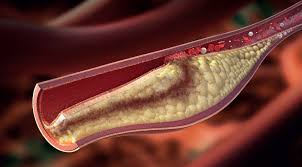 High Cholesterolemia in Dubai