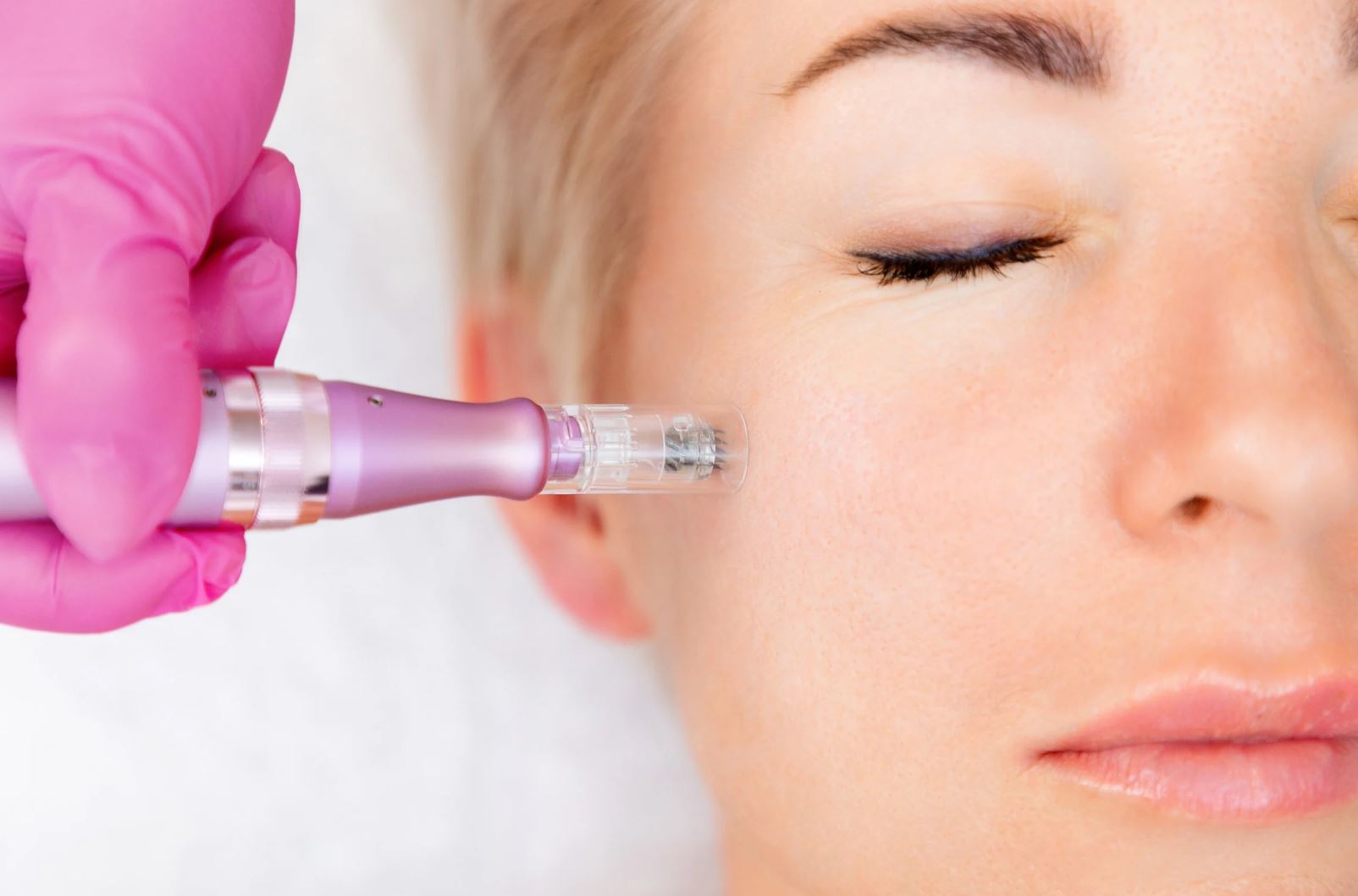 microneedling cost per session