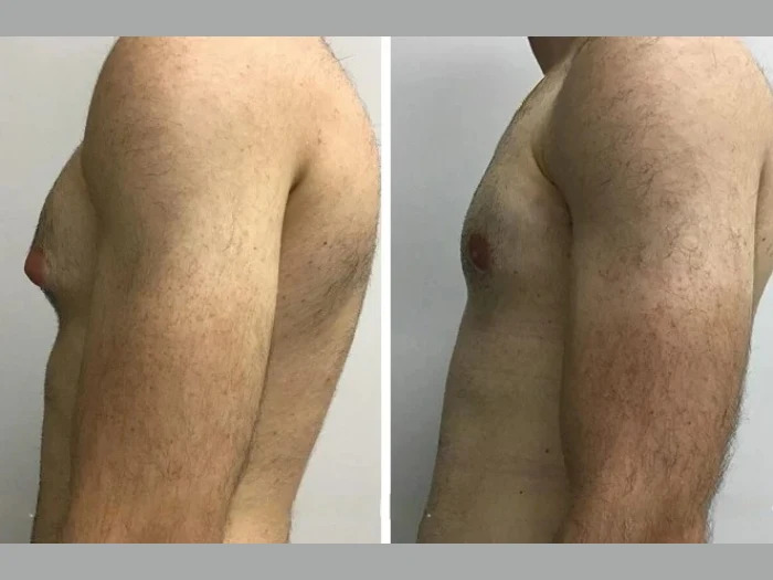 Gynecomastia Surgery in Dubai with High Patient Satisfaction